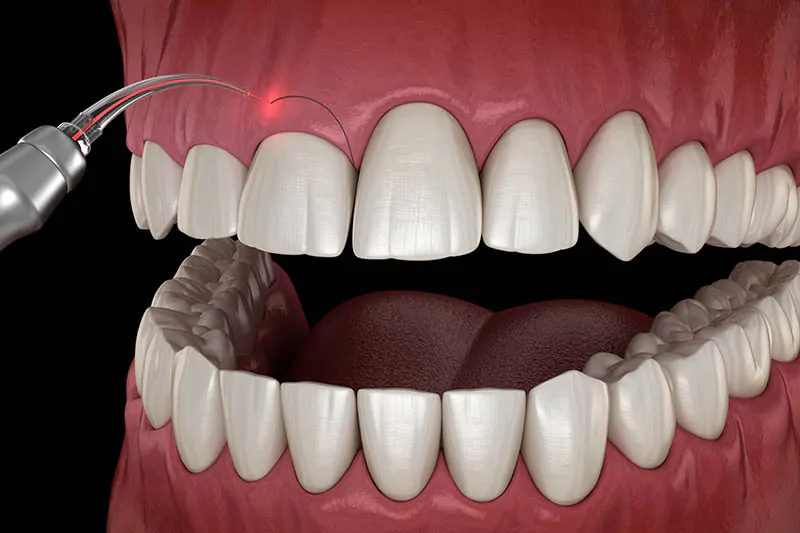Dental Implants